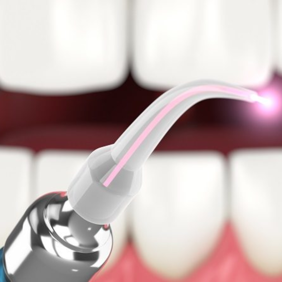 Эрбиевый лазер в стоматологии. Лазерная терапия пародонтита. Лазерные технологии в стоматологии. Пластика десен лазером. Лазерное десен